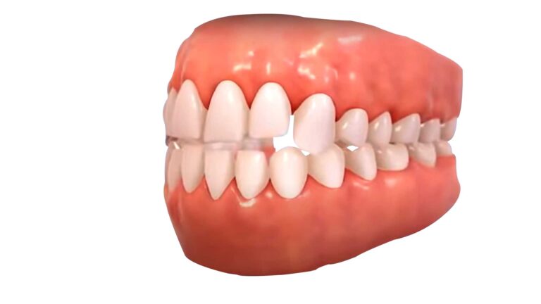 Open Bite