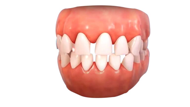 Teeth With Gaps
